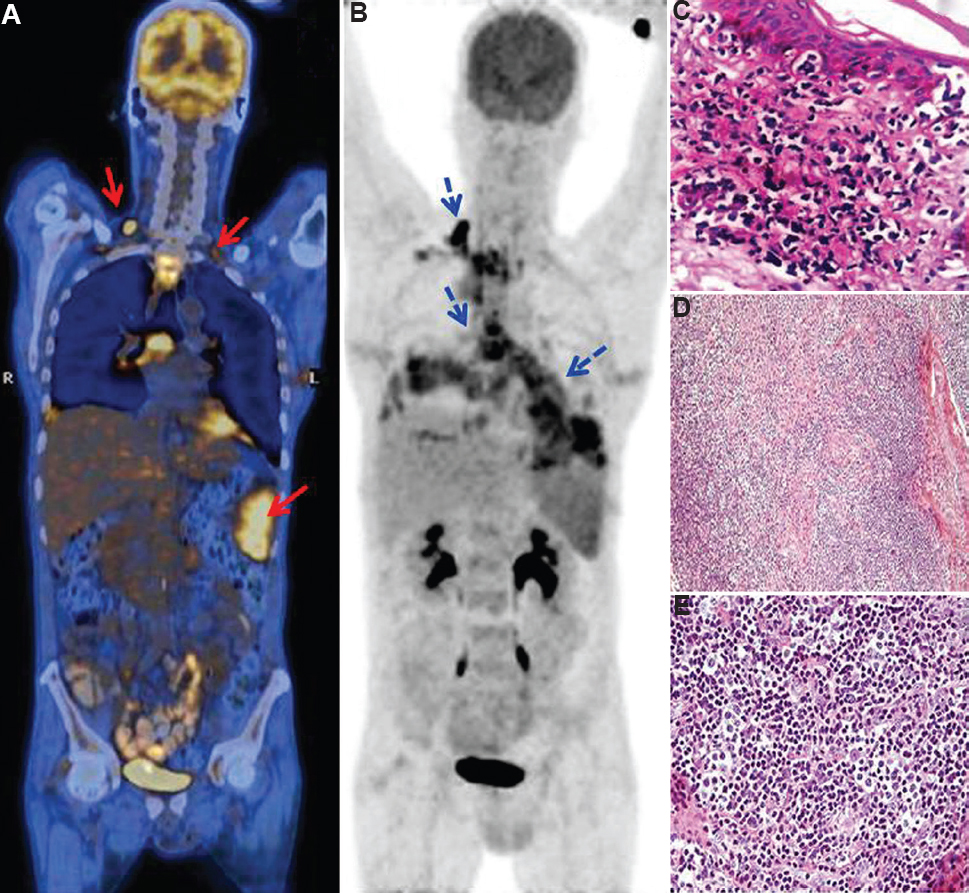 (A) Fused coronal 18F FDG PETCT (Fluorodeoxyglucose positron emission tomography –computed tomography) image (head to mid-thigh) shows FDG avid bilateral lower cervical lymph nodes (arrows, SUV Max 3.4) and additional splenic involvement (SUV Max 6.7), thereby upstaging NHL to Stage IIE, as per Ann Arbor classification. (B) Coronal PET images (arrow) depict FDG avid retropharyngeal collection and sinus tracking into prevascular, paracardiac spaces, around pericardium and into mediastinum on both sides (SUV Max 17.2). Infection was also noted beneath the right sternocleidomastoid. A large FDG avid subcarinal node was also noted. (C) High-resolution magnified skin biopsy sections H and E, ×40 showing thinned out epidermis, lymphoid infiltrate at dermoepiderma junction with cytological atypia. Cells showing epidermotropism and Pautrier's microabscess formation – suggesting Cutaneous T cell lymphoma. (D) Low-magnification images of subcarinal lymph node biopsy showing infiltration of polymorphic cells with high endothelial venule-like vessels (H and E, ×10) mimicking IRIS. (E) High magnified image of lymph node H and E, ×40 shows proliferation of medium to large-sized lymphoid cells with a clear cytoplasm (clear cells). The cells are CD3+ and CD4+. Findings are mimicking immune reconstitution inflammatory syndrome type I but clinical condition improved with antifungal therapy.